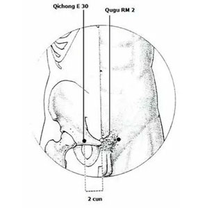 ilustración de aplicación implante de placenta